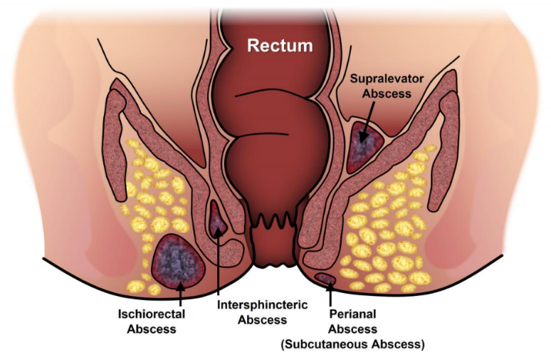 Fistula Treatment