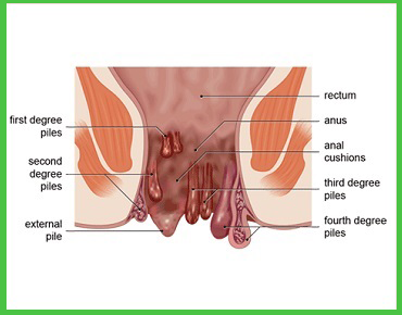 Piles Treatment